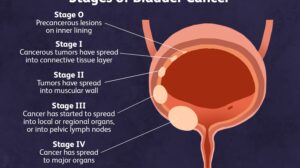 Bladder cancer development stage