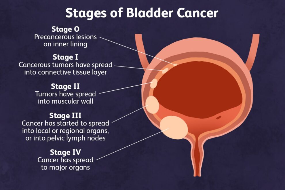 Bladder cancer development stage