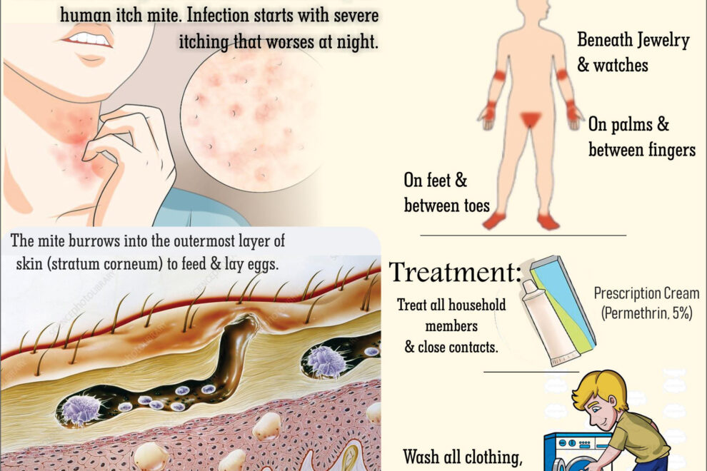 Scabies – Symptoms and Causes