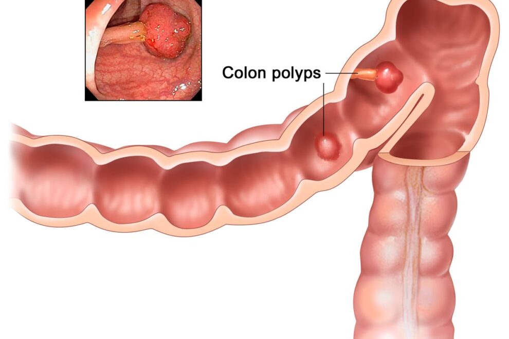 Polyps in the stomach