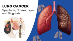 Lung Cancer Symptoms